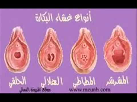 فض غشاء البكاره