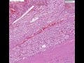 Histopathology Kidney-- Renal cell carcinoma Renal Cell Cancer