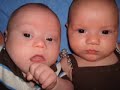 Down syndrome:&nbsp;Down Syndrome Twins