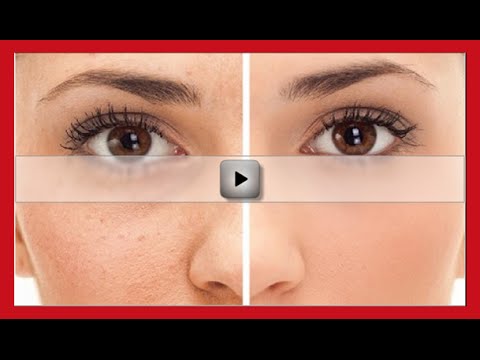 how to fill pimple holes