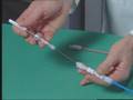 stent retrieval