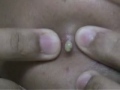 Busting A Pimple