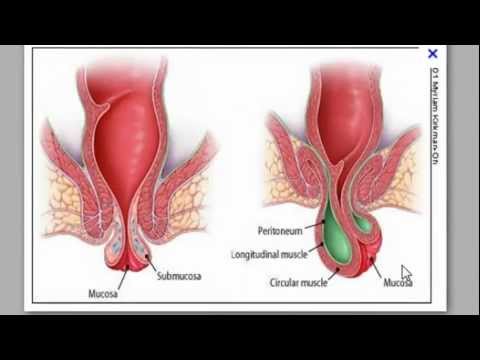 how to cure almoranas