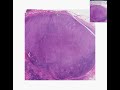 Histopathology Lymph node--Anaplastic large cell lymphoma