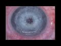 Lasik with IntraLase