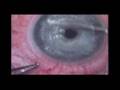 Lasik with IntraLase
