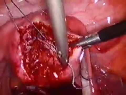 subtotal hysterectomy