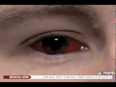 Corneal tattooing in medisch jargon. YouTube Preview Image