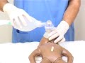 Basic neonatal resuscitation: prolonged ventilation with normal heart rate(hindi)