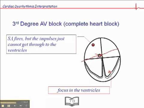 how to treat 3rd degree heart block