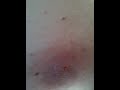 Cyst Part 2.6....