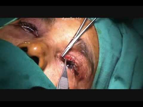 how to treat ptosis