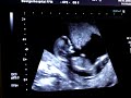 ultraschall, 13 Woche, baby h�pft