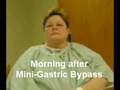 South Carolina Patient morning after Mini-G…