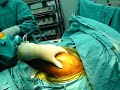 Shoulder dislocation preoperative stability test ???????????