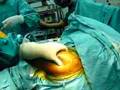 Shoulder dislocation preoperative stability test ข้อไหล่หลุด