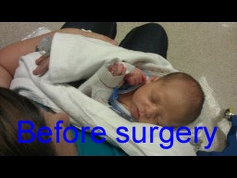 how to repair pyloric valve