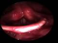 My Larynx - High Speed Video