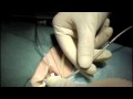 Endovascular Cooling Catheter Placement