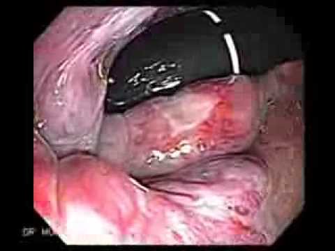 how to treat internal hemorrhoids