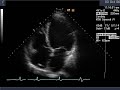 Dilated Cardiomyopathy Cardiomyopathy