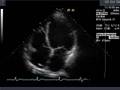 Dilated Cardiomyopathy