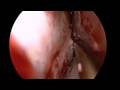 Septoplasty by Using The Septal Stapler (HD Quality) Septoplasty by Using The Septal Stapler (HD Quality)