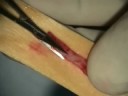 Gingival Grafting