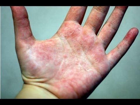 how to treat dermatitis on hands