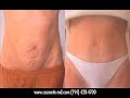 Liposuction Westchester Liposuction Westchester