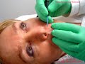 Radio Surgery Mole and Skin Tag Removal