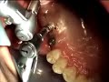 Implant failure 1.2