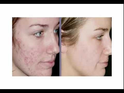how to get rid of keloid c-section scar