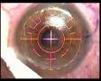 Lasik in Melbourne Lasik in Melbourne