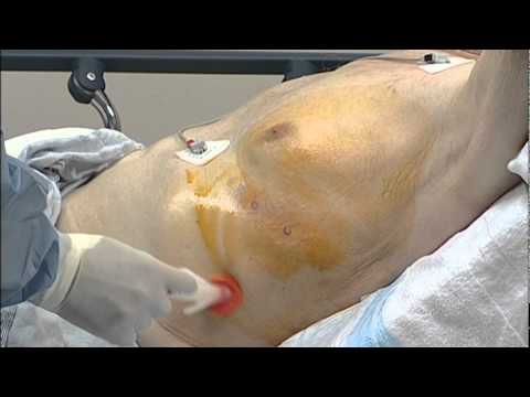 Pleurx - Clinical video for physicians, demonstrating the procedural steps for implanting a medical device in the chest cavity.