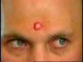 The Zit The Zit