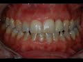 CeraRoot & CeraCrown cementation (lateral incisor) CeraRoot & CeraCrown cementation (lateral incisor)