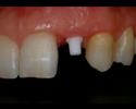 CeraRoot & CeraCrown cementation (lateral incisor)