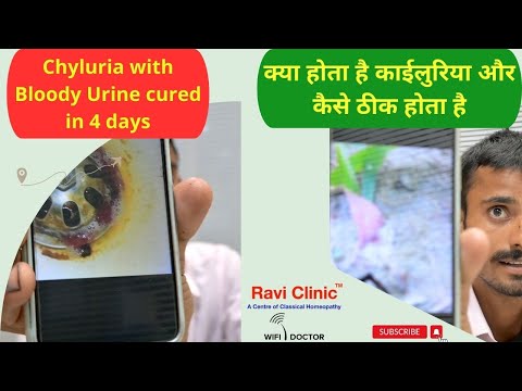 Chyluria with Milky and Bloody Urine got cured in 4 days
