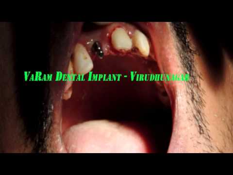 how to treat avulsed tooth