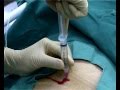 www.mediplus.co.uk A new and safer method of inserting a Foley catheter suprapubically. The technique allows the insertion to be carried out in an Outpatient setting, thus saving time, cost and effort. By using the Seldinger technique, the product reduces the chances of bowel or bladder perforation and resultant morbidity. The product has been chosen by The NHS National Technology Adoption Centre to help facilitate adoption of the product.
