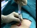 Mediplus Ltd Suprapubic Foley Catheter Introducing Set - S-Cath