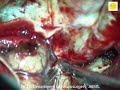 Neurosurgery video Anterior communicating artery + ICA clinoidal aneurysm clipping