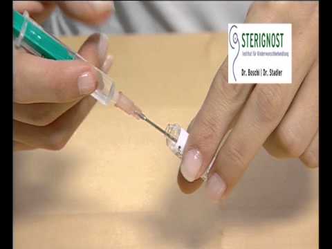 how to administer pregnyl