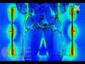 Hyperthermia Treatment