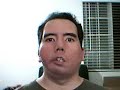 Moebius Syndrome