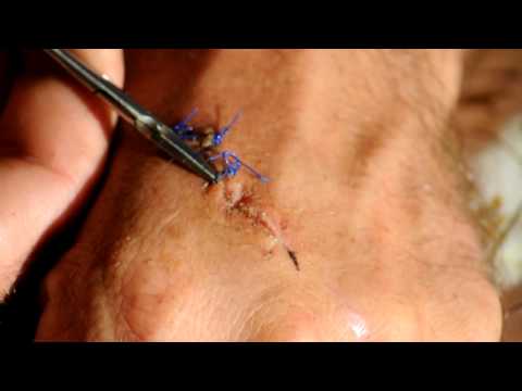 how to dissolve absorbable sutures