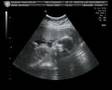 Life in the Womb III: 22 weeks ultrasound