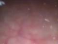 Cystoscopy