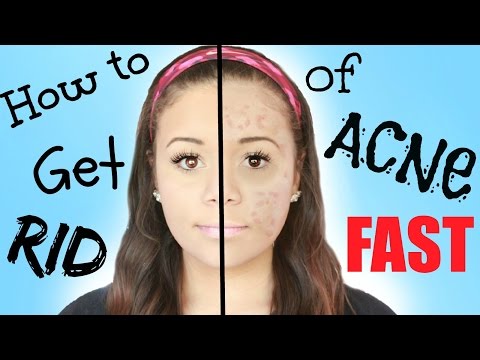 how to get rid of an acne fast
